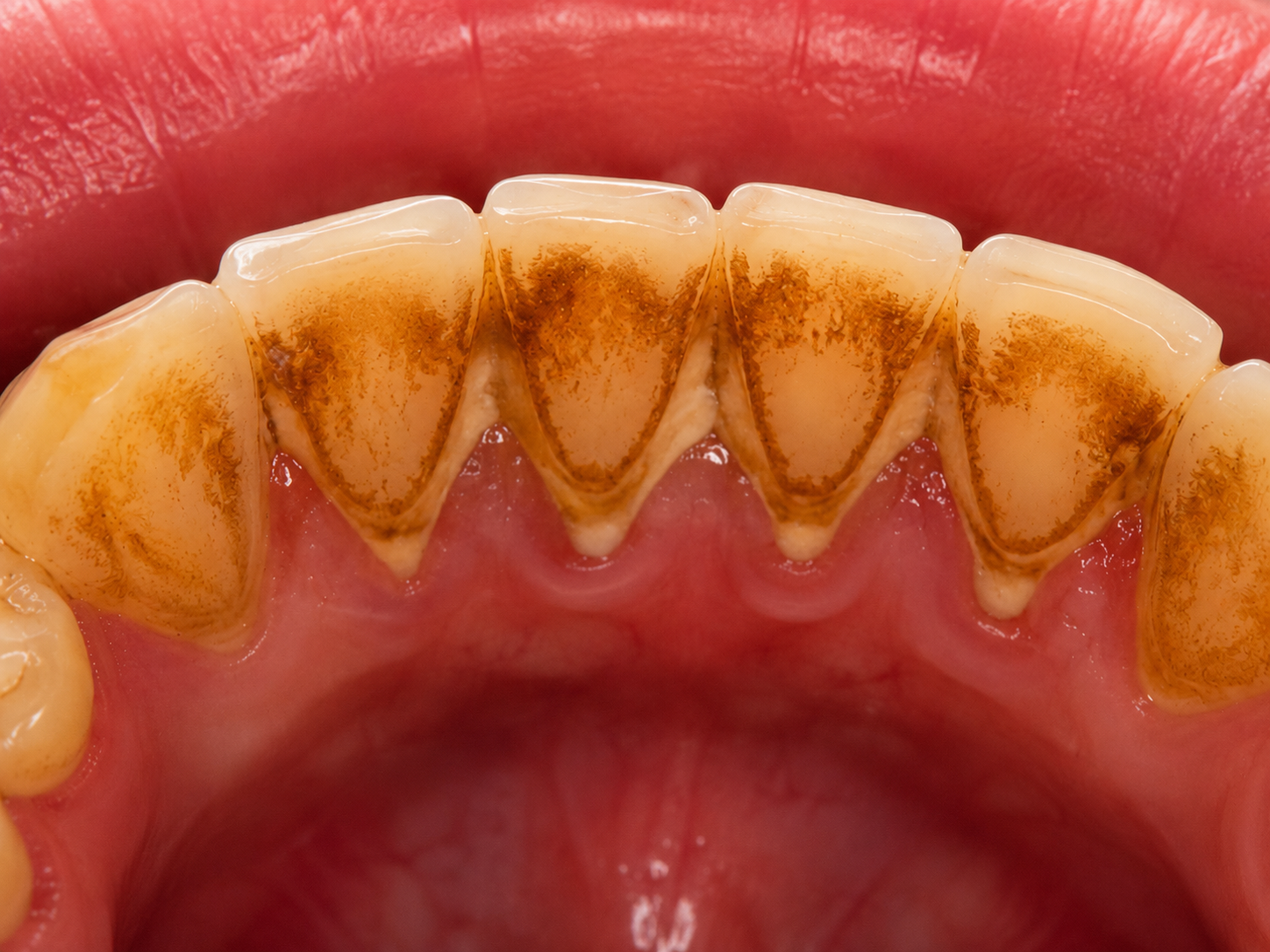 Dental Cleaning before treatment